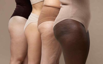 Celulitis: qué es y cómo combatirla